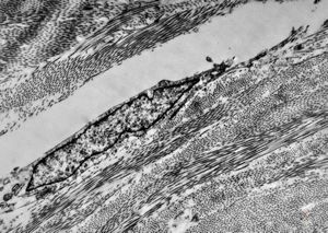 F,42y. | pseudoangiomatous hyperplasia